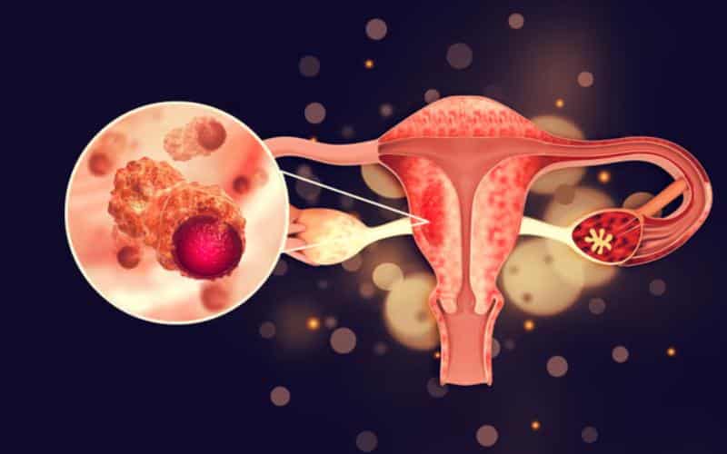 Ovarian Cancer